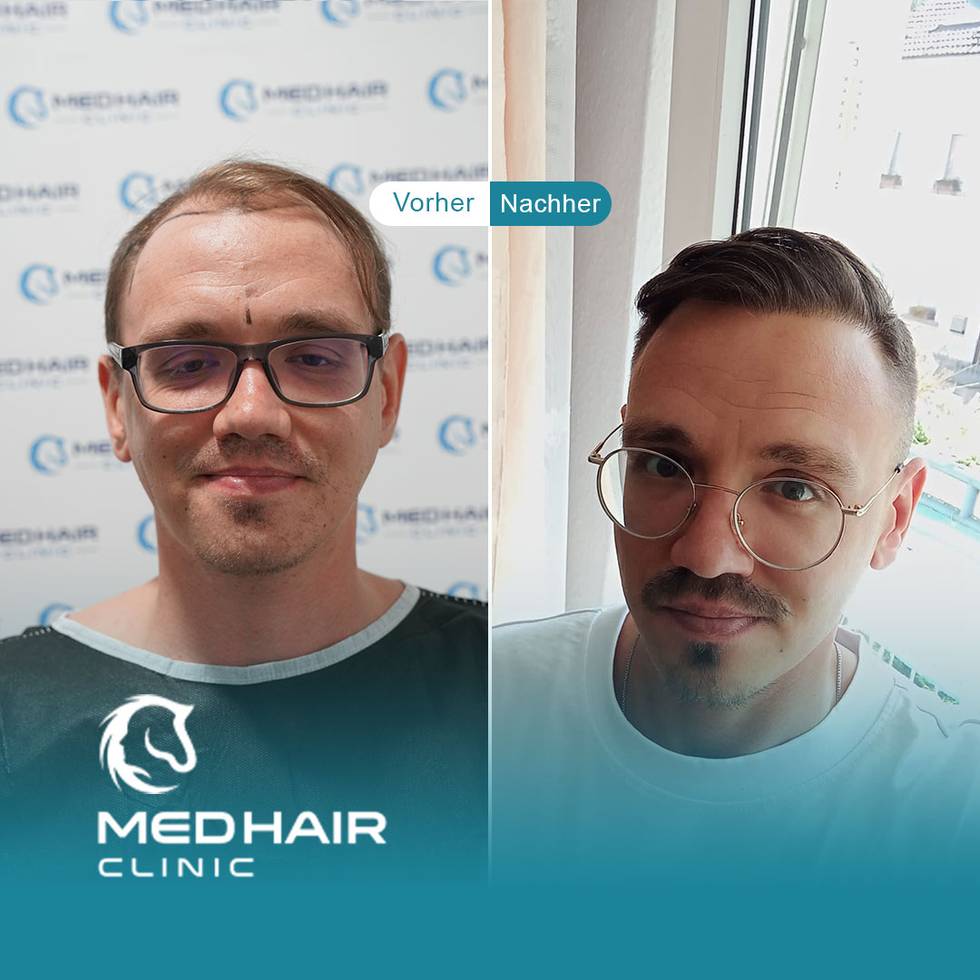 haartransplantation-tuerkei-vorher-nachher.jpeg haartransplantation-tuerkei-vorher-nachher.jpeg